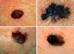 Cancer de la peau et insolation